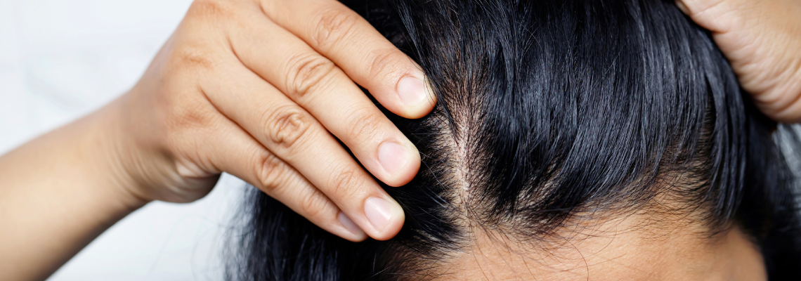 Hair Fall in Women: Gut Imbalances, Nutrient Deficiencies, and Stress